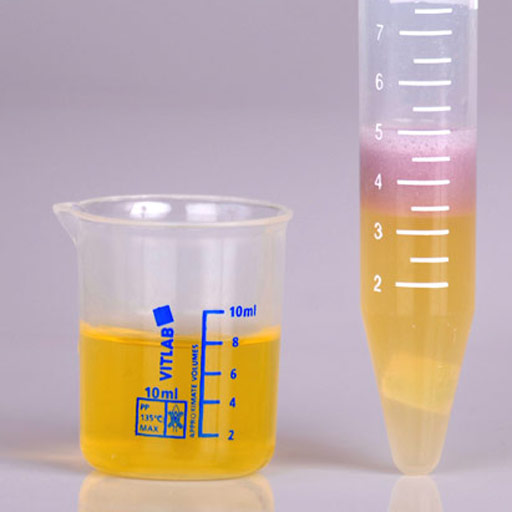 Heavy metal test with urine show toxic metals.