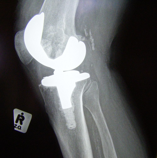 Titanium calcium toxicity sources include bone implants